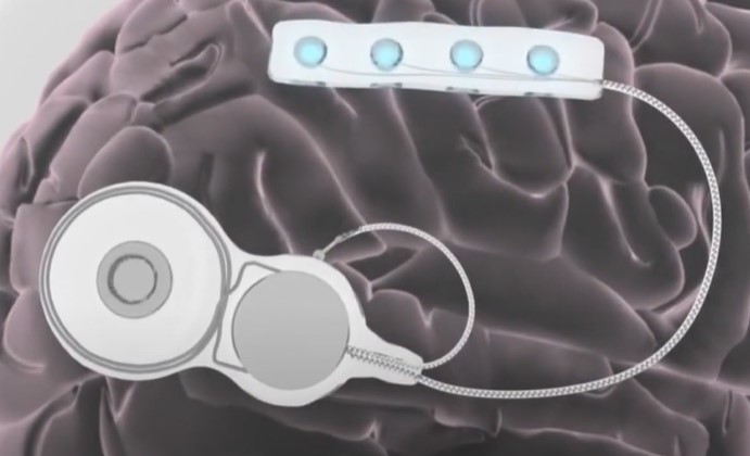 Illustration of epi-minder device implanted on brain 