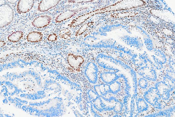 This image is a bowel tissue section stained with DNA mismatch repair gene immunohistochemistry. The image was taken at the Victorian Comprehensive Cancer Centre. The Wurundjeri Woi-wurrung people of the Kulin Nation are the Traditional Owners of the land in Parkville.