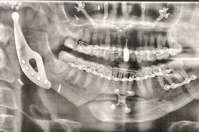 A human jaw seen through X-rays with a medical device embedded